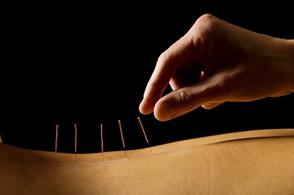 Picture of acupuncture